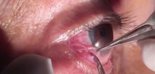 eye 
